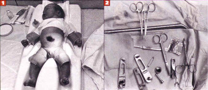 Hospital Circumcision1-2.jpg (25 KB)